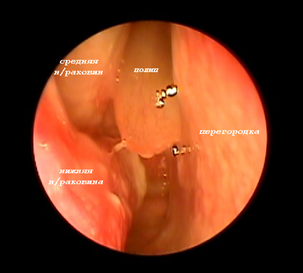 Полипы в носу (полипозный риносинусит)